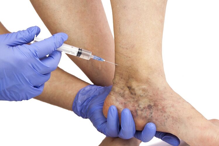 Injection for varicose veins