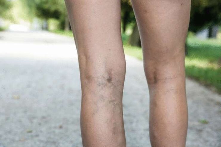 Varicose veins in the legs