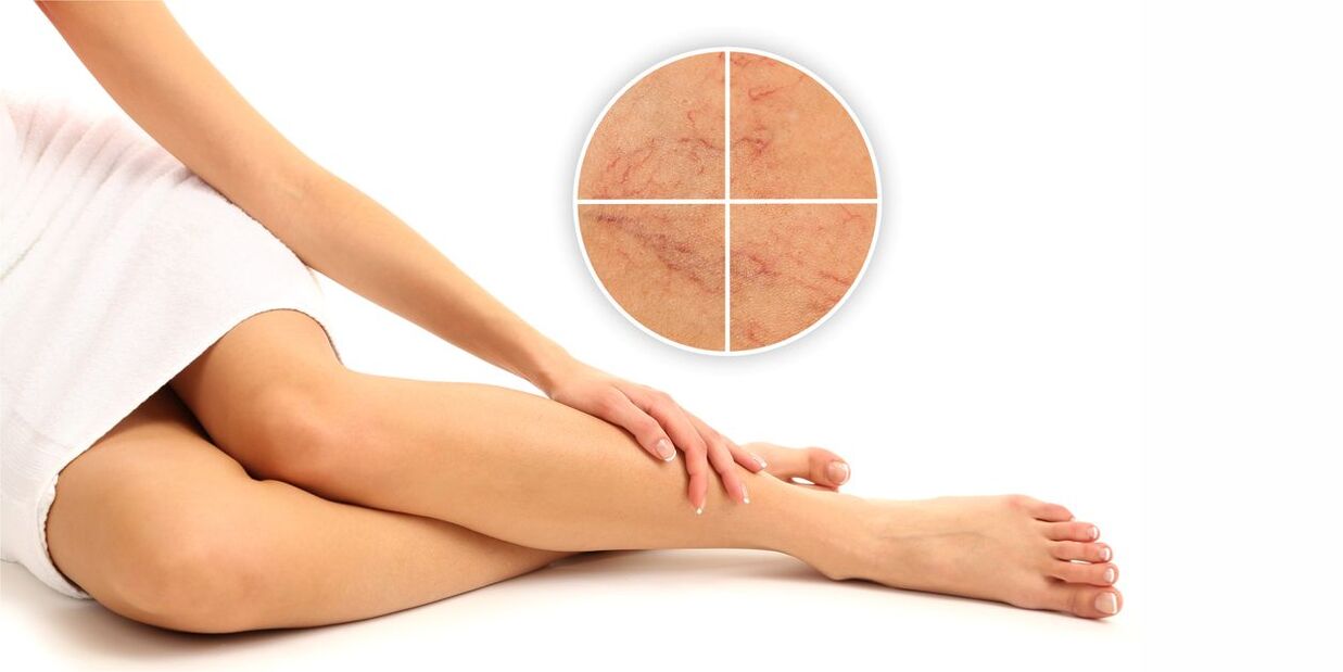 What are varicose veins on the legs
